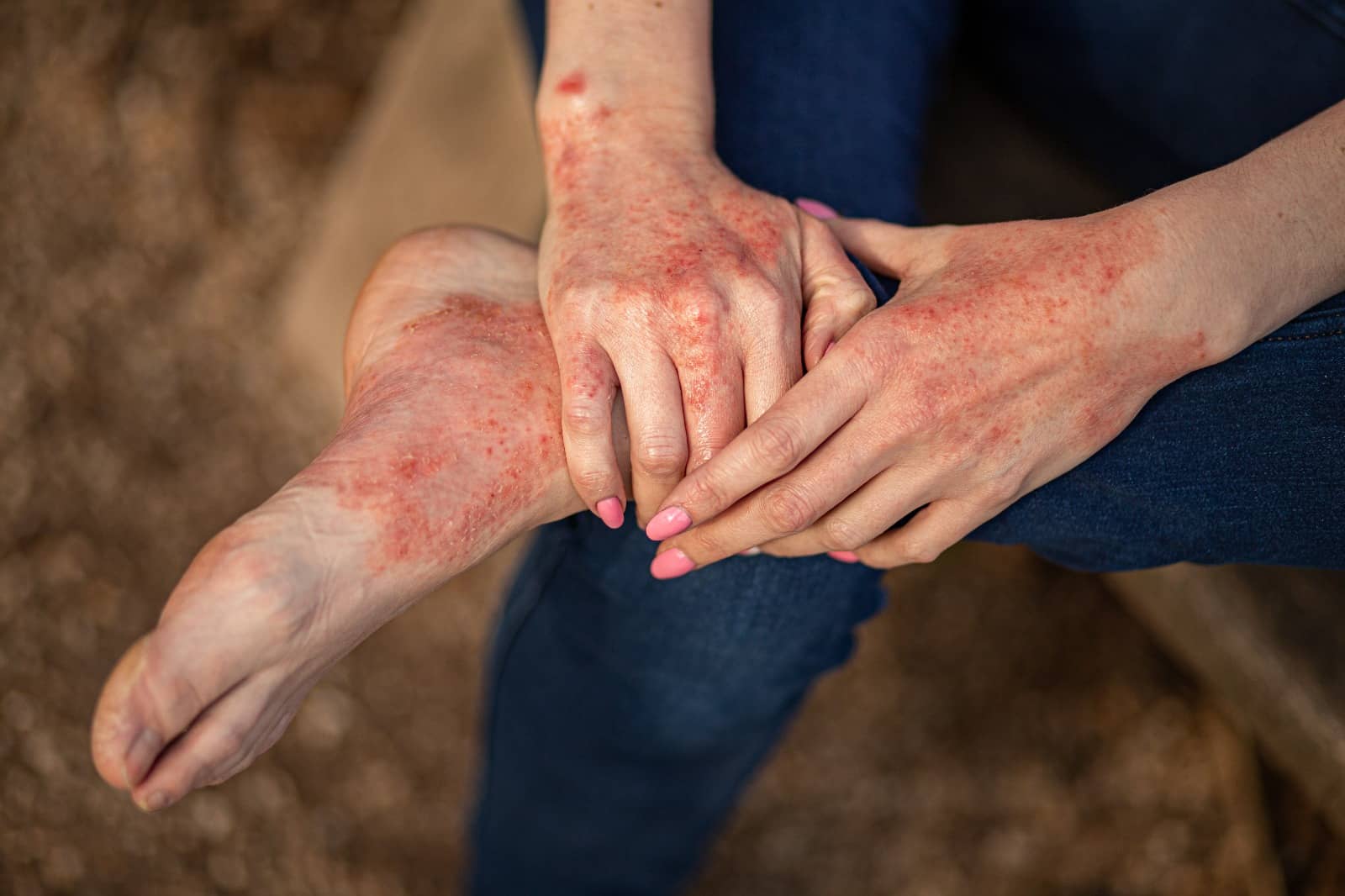 Eczema in Winter: Dry Skin Triggers, Treatment and Dermatologist Advice